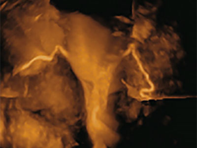 צילום רחם או הדמיית הרחם והחצוצרות?