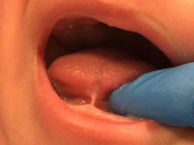 לשון קשורה - התרת לשון קשורה